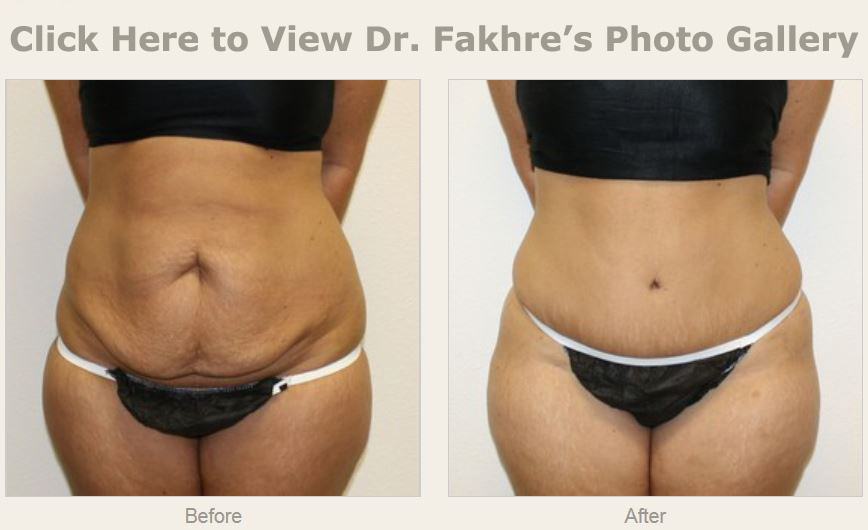 abdominal plastic surgery abdominal plastic surgery