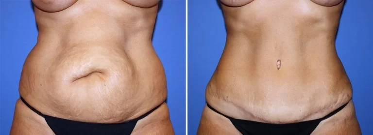 Abdominal Plastic Surgery: Reshaping the midsection