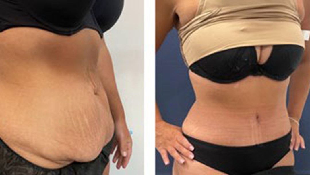 abdominoplasty cost