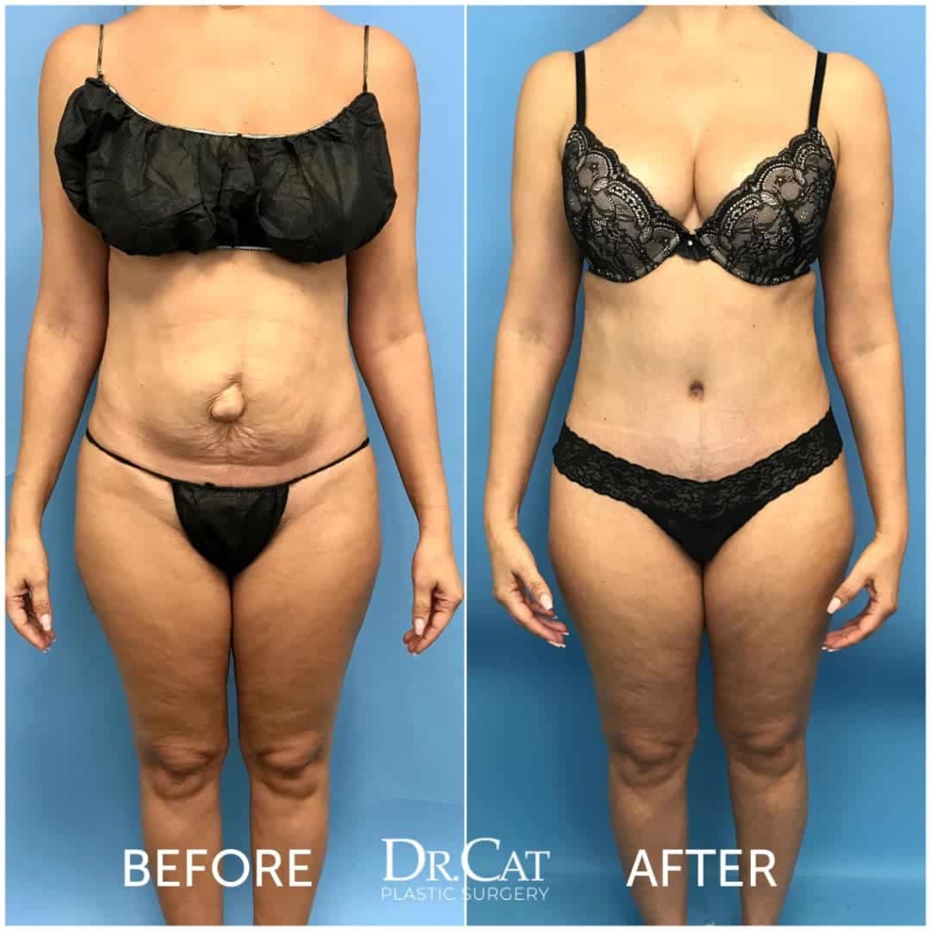 abdominoplasty cost