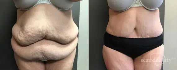 Abdominoplasty cost: What to expect when budgeting for a tummy tuck
