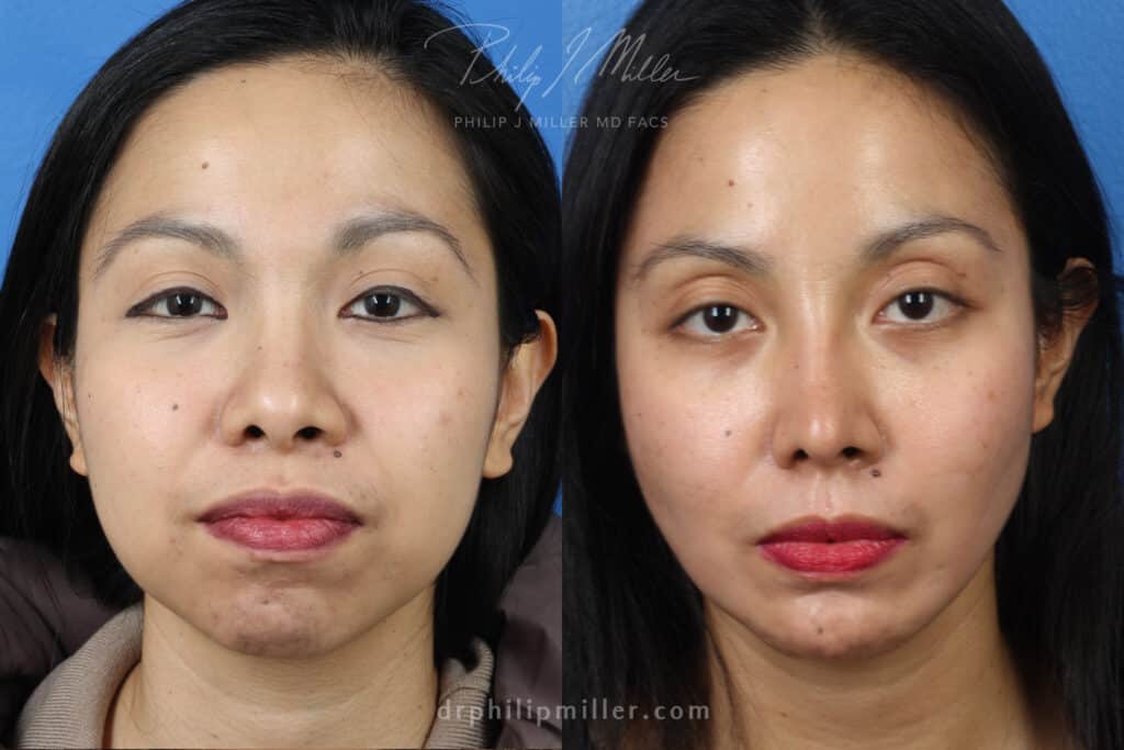 alarplasty cost