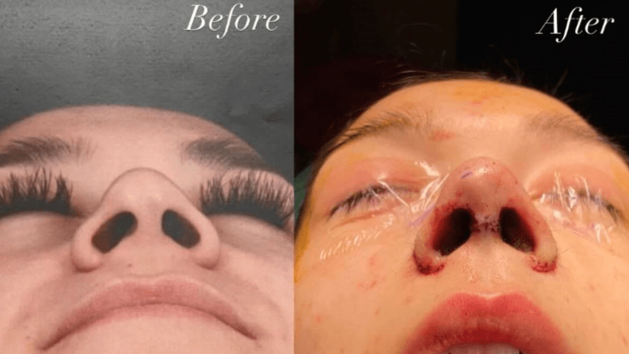 alarplasty cost