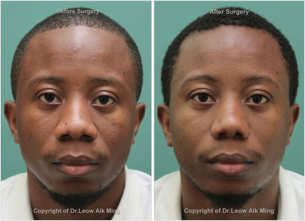 alarplasty cost