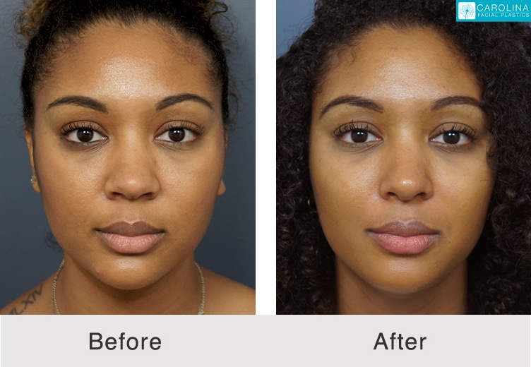 Alarplasty cost: Narrowing and reshaping the nostrils