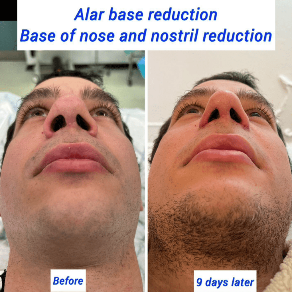 alarplasty cost