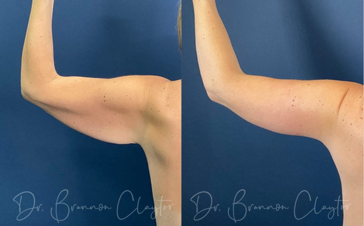 arm lift arm lift