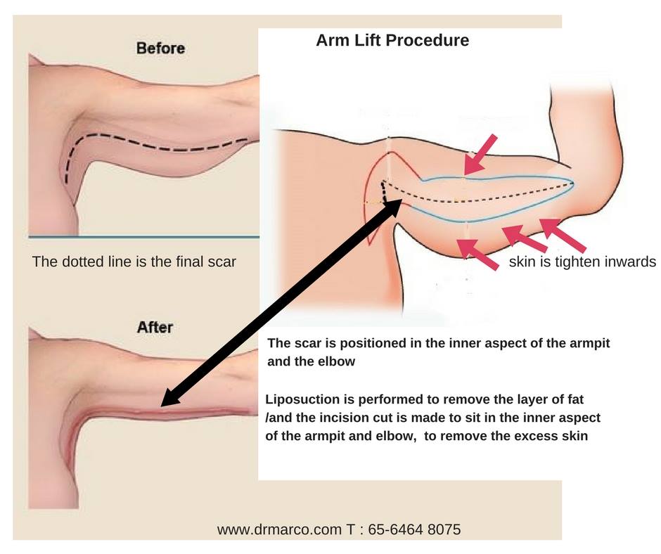 arm lift arm lift