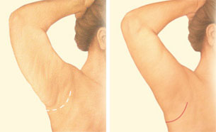 arm lift arm lift
