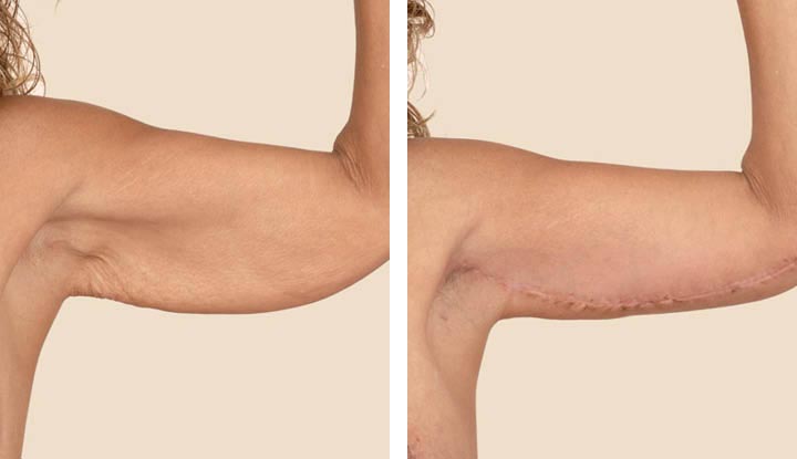 Arm lift: Achieving toned, sculpted upper arms