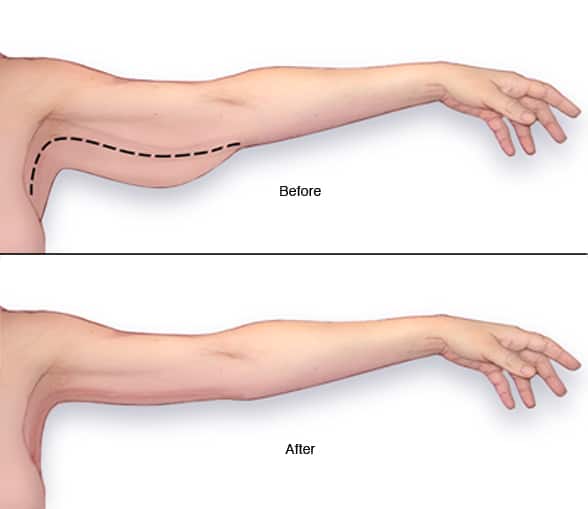 arm lipo cost