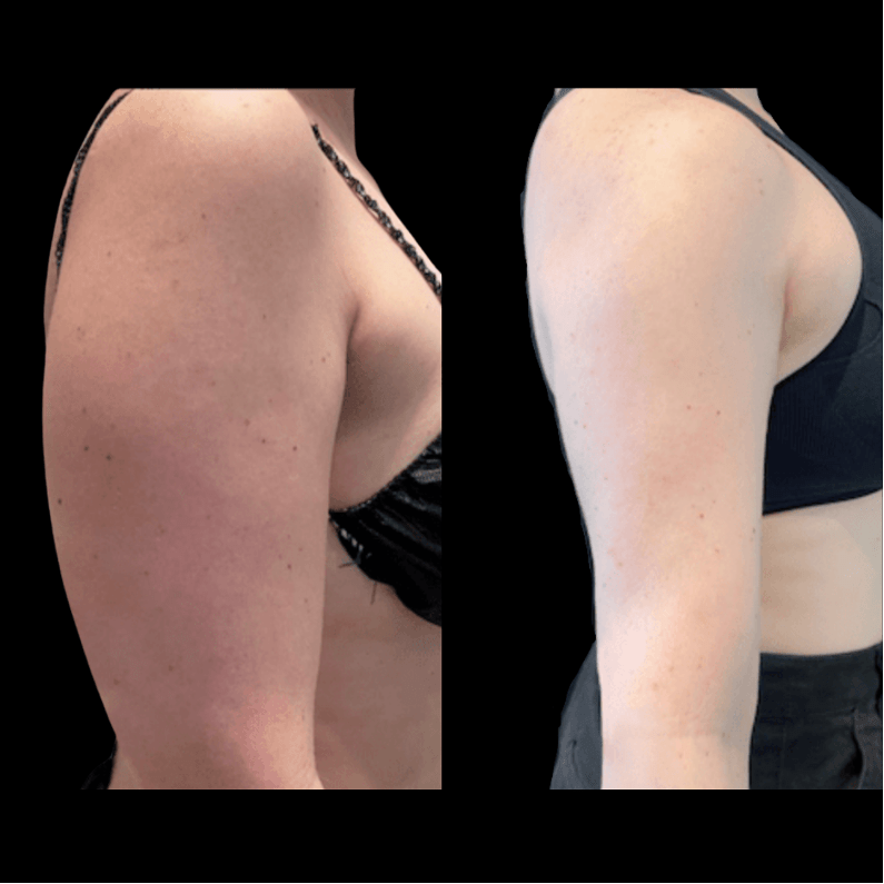 arm lipo cost