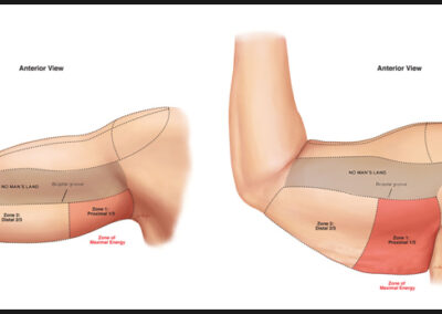 arm liposuction arm liposuction