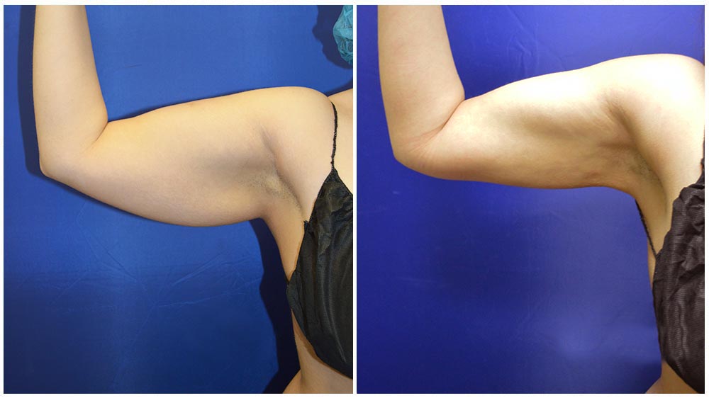arm liposuction arm liposuction