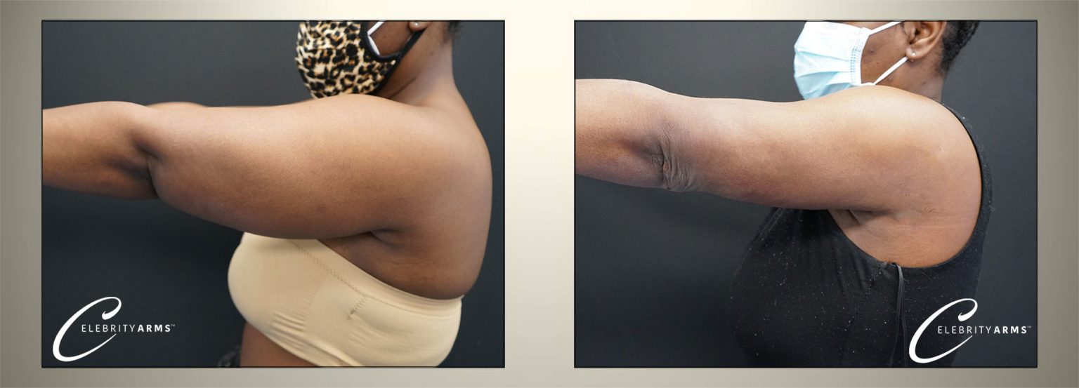 arm liposuction arm liposuction