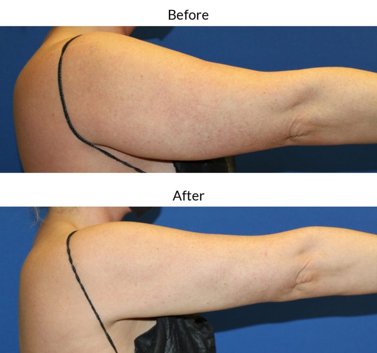 Arm Liposuction: What to Expect and Recovery Tips