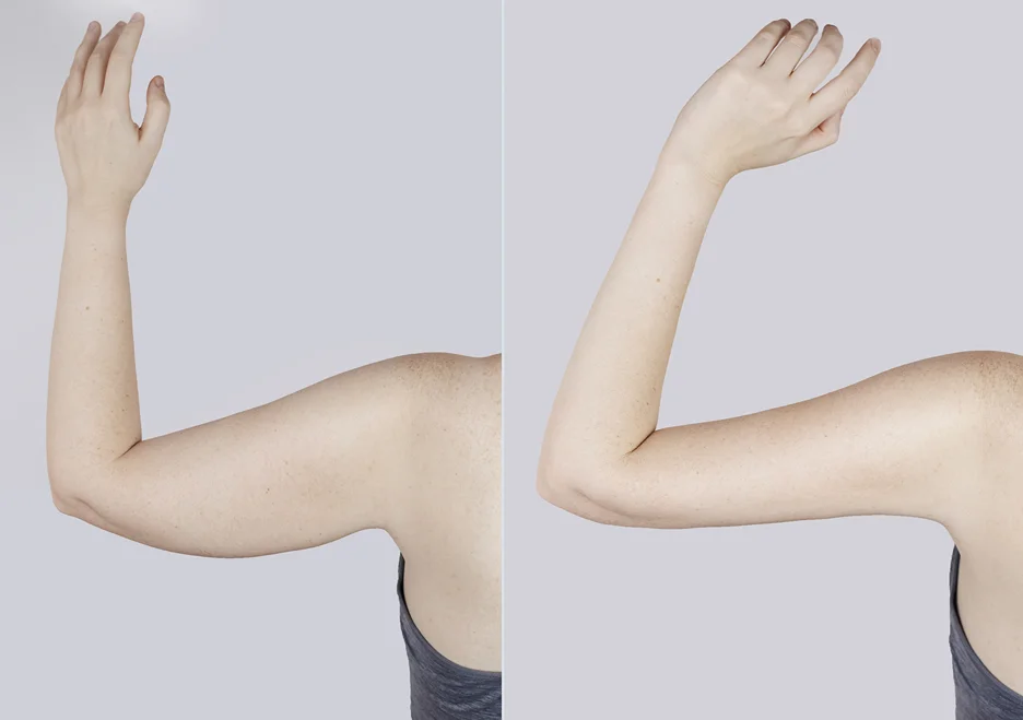 arm liposuction arm liposuction