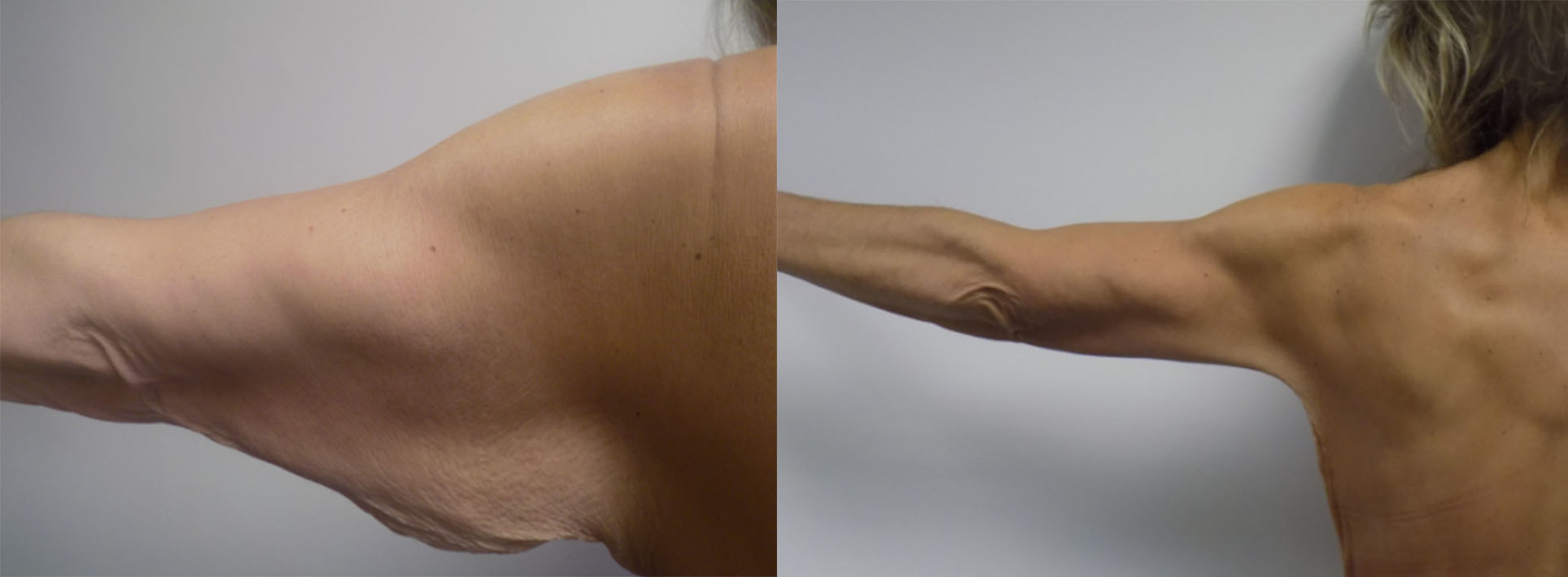 arm skin removal surgery arm skin removal surgery