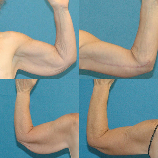 arm skin removal surgery arm skin removal surgery