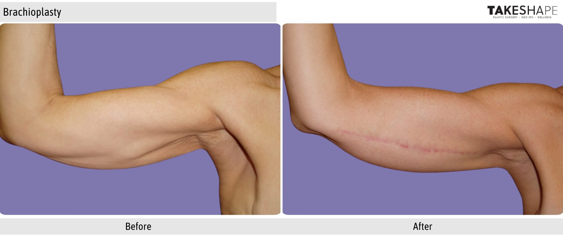 arm skin removal surgery arm skin removal surgery