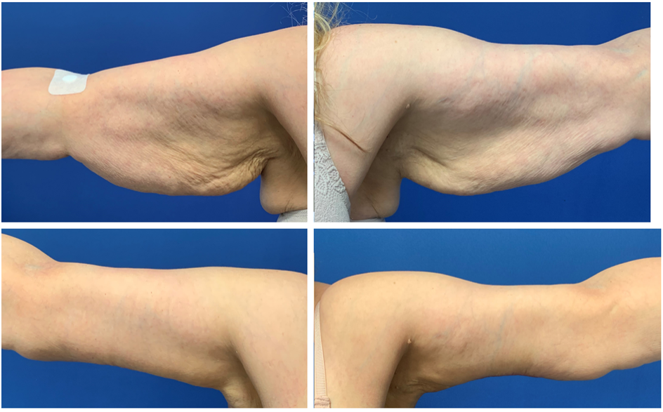 arm skin removal surgery arm skin removal surgery