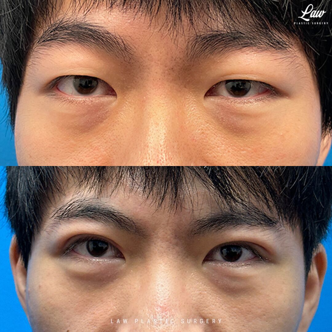 asian plastic surgery asian plastic surgery