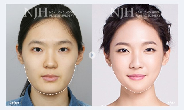 Asian plastic surgery trends: Innovations and popular techniques