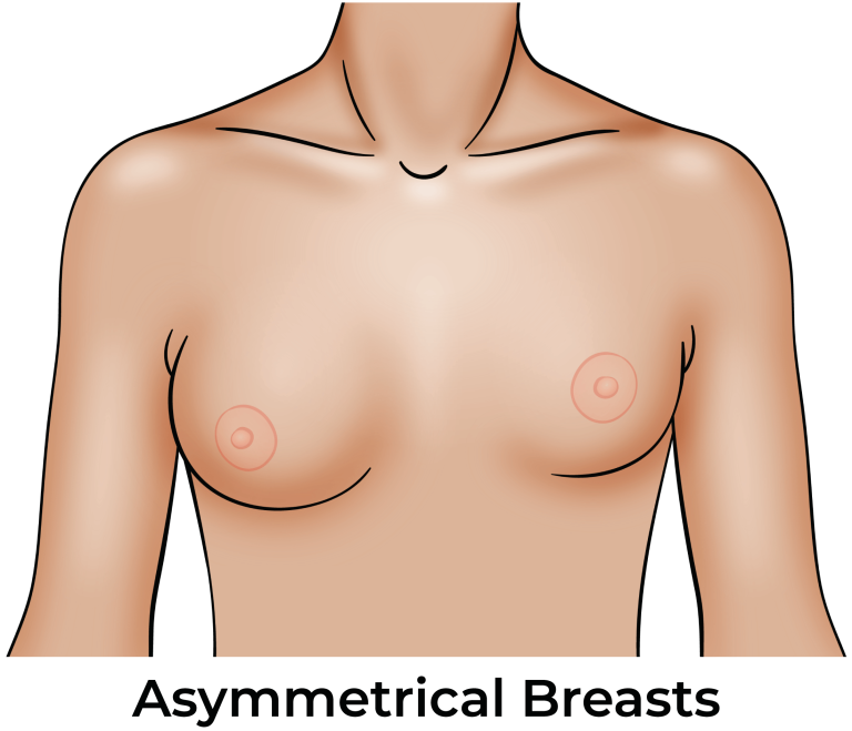 Asymmetrical breast correction: Achieving balance and symmetry