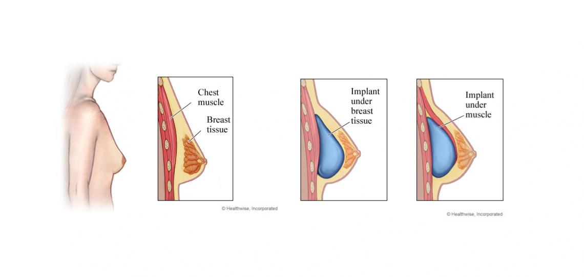 augmentation mammoplasty augmentation mammoplasty