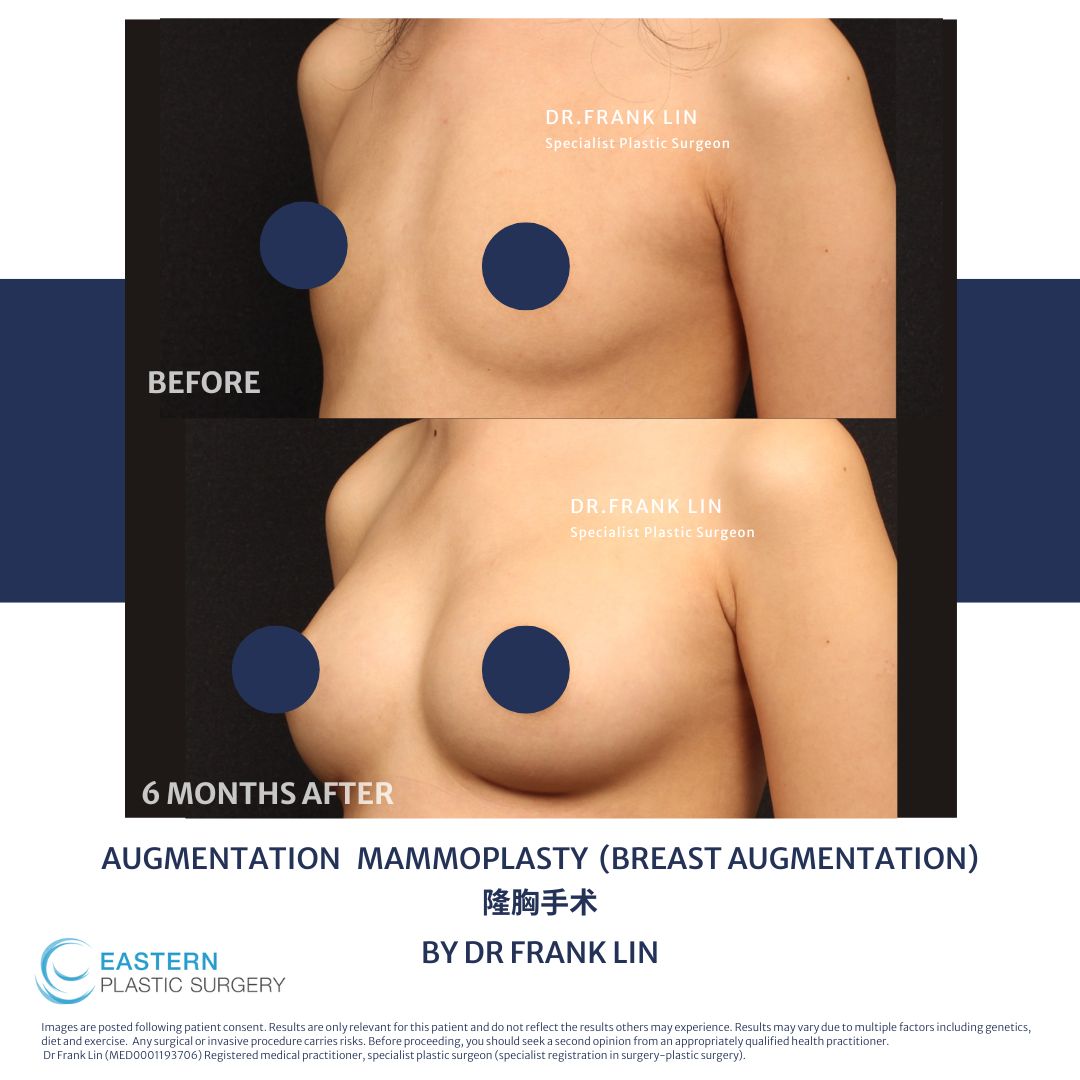 augmentation mammoplasty augmentation mammoplasty