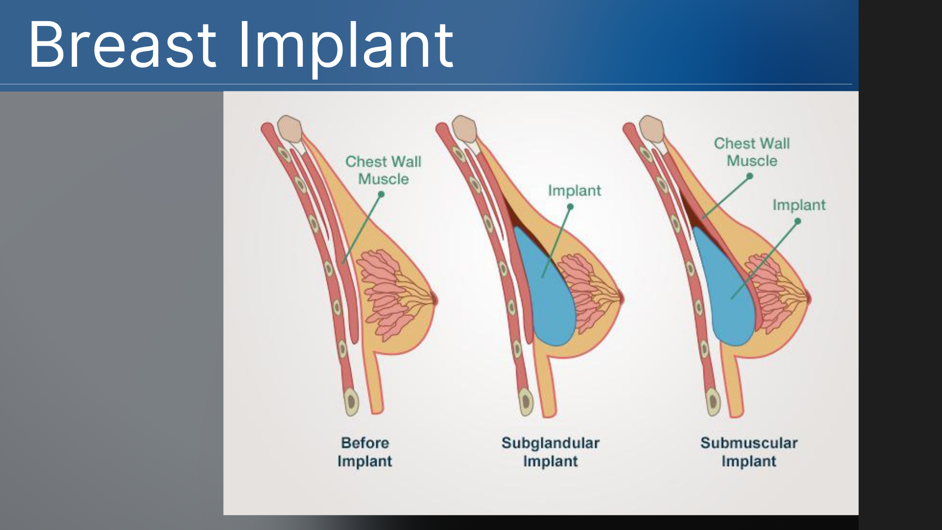 augmentation mammoplasty augmentation mammoplasty