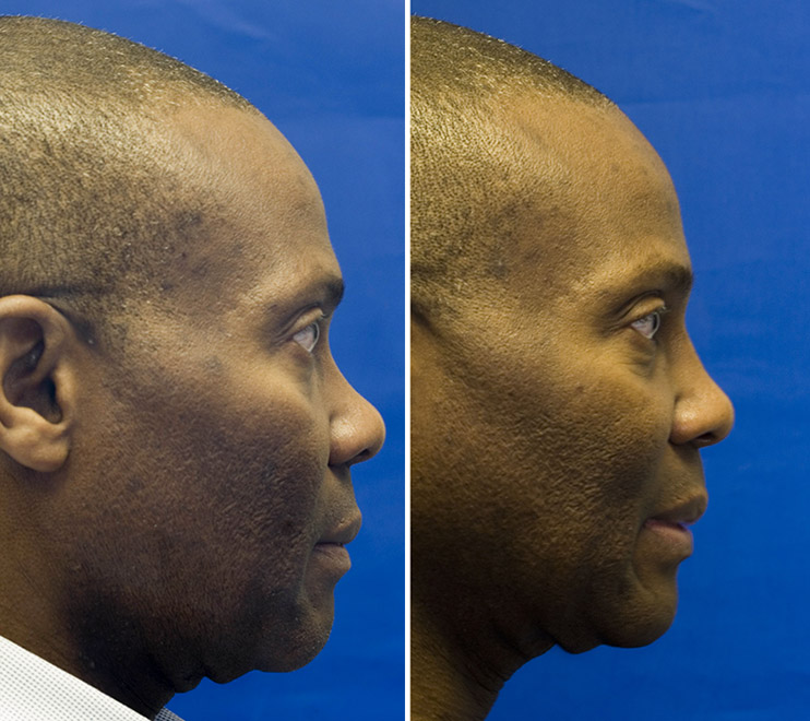 augmentation rhinoplasty