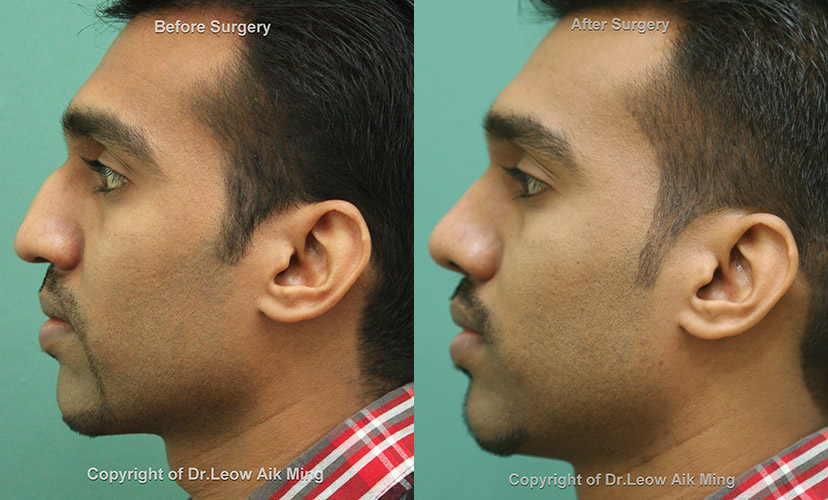 augmentation rhinoplasty