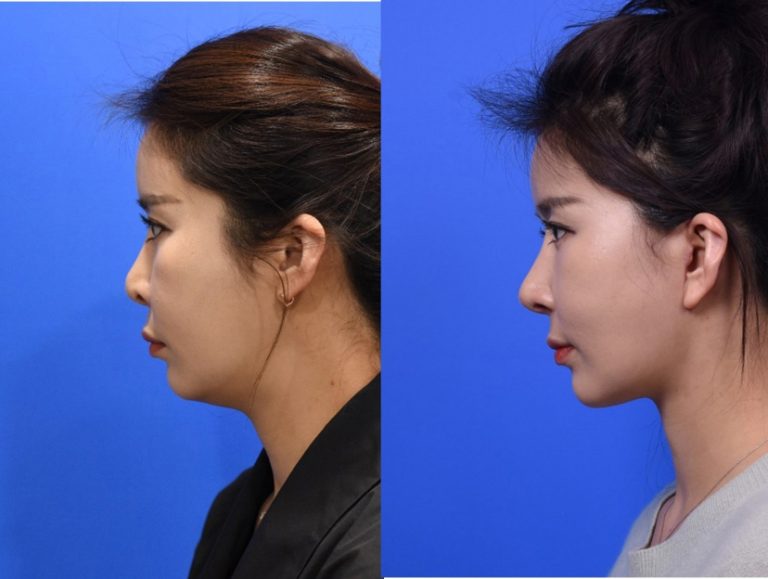 Augmentation Rhinoplasty: Enhancing nasal features