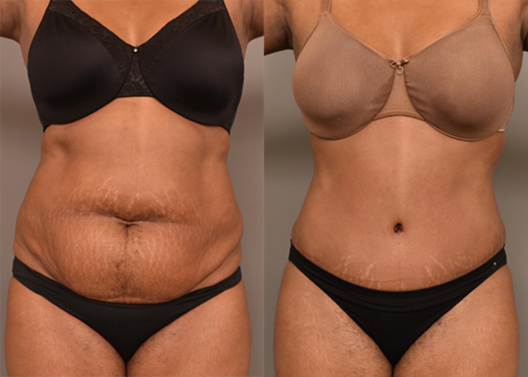 average cost of tummy tuck