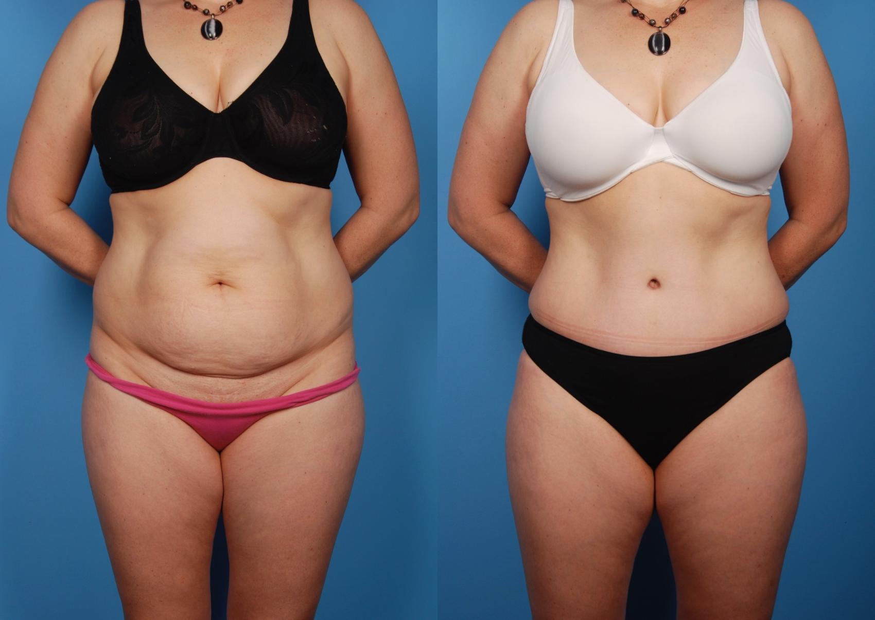 average cost of tummy tuck