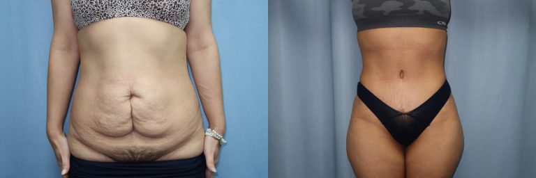 Average cost of a tummy tuck: Breaking down the price factors