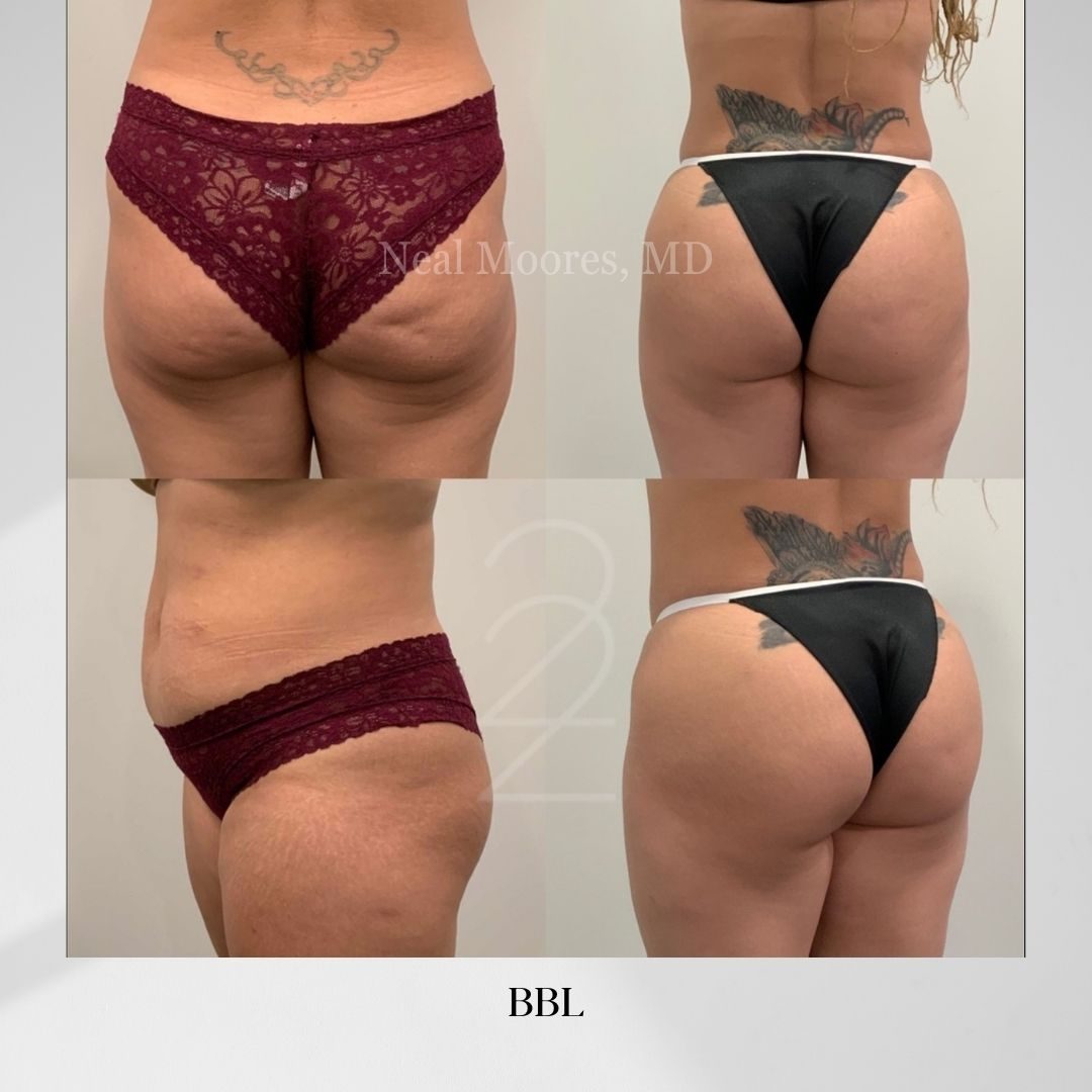 bbl butt lift