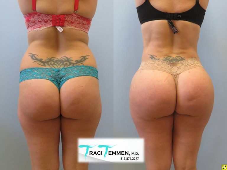 BBL butt lift: Sculpting curves with Brazilian Butt Lift