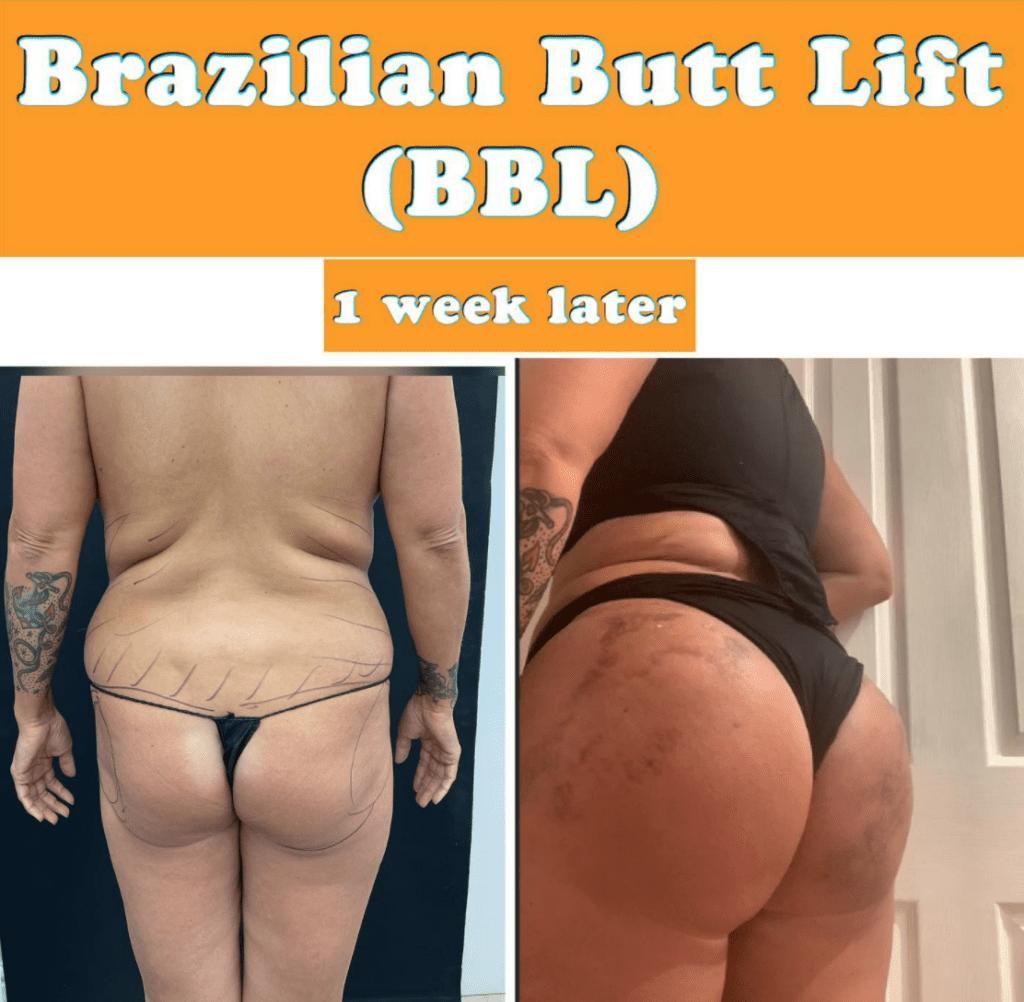 bbl butt lift