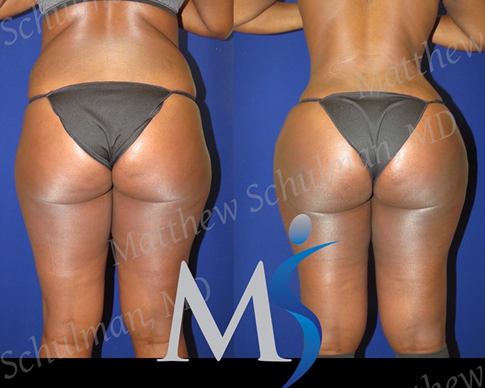 BBL Doctors: Experts in sculpting curves