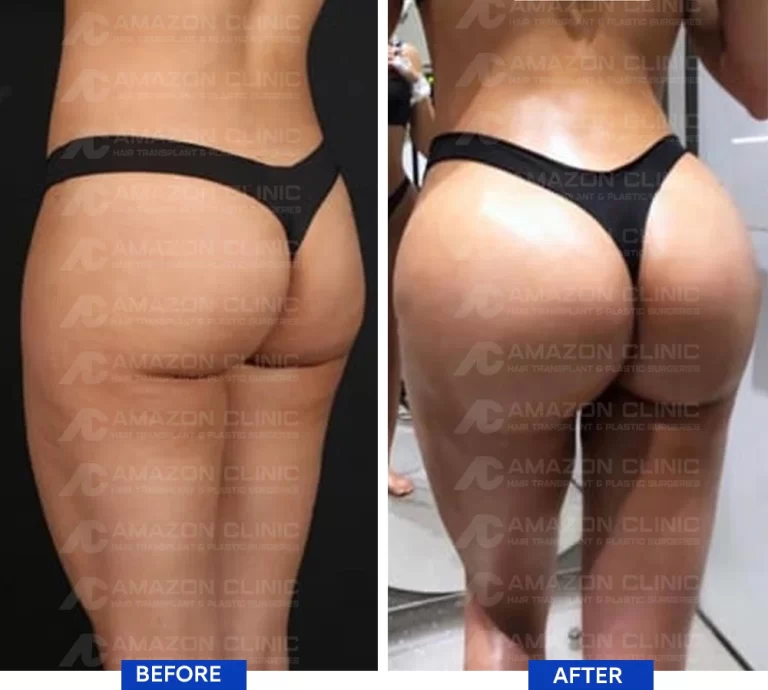 BBL Plastic Surgery: Sculpting your ideal curves