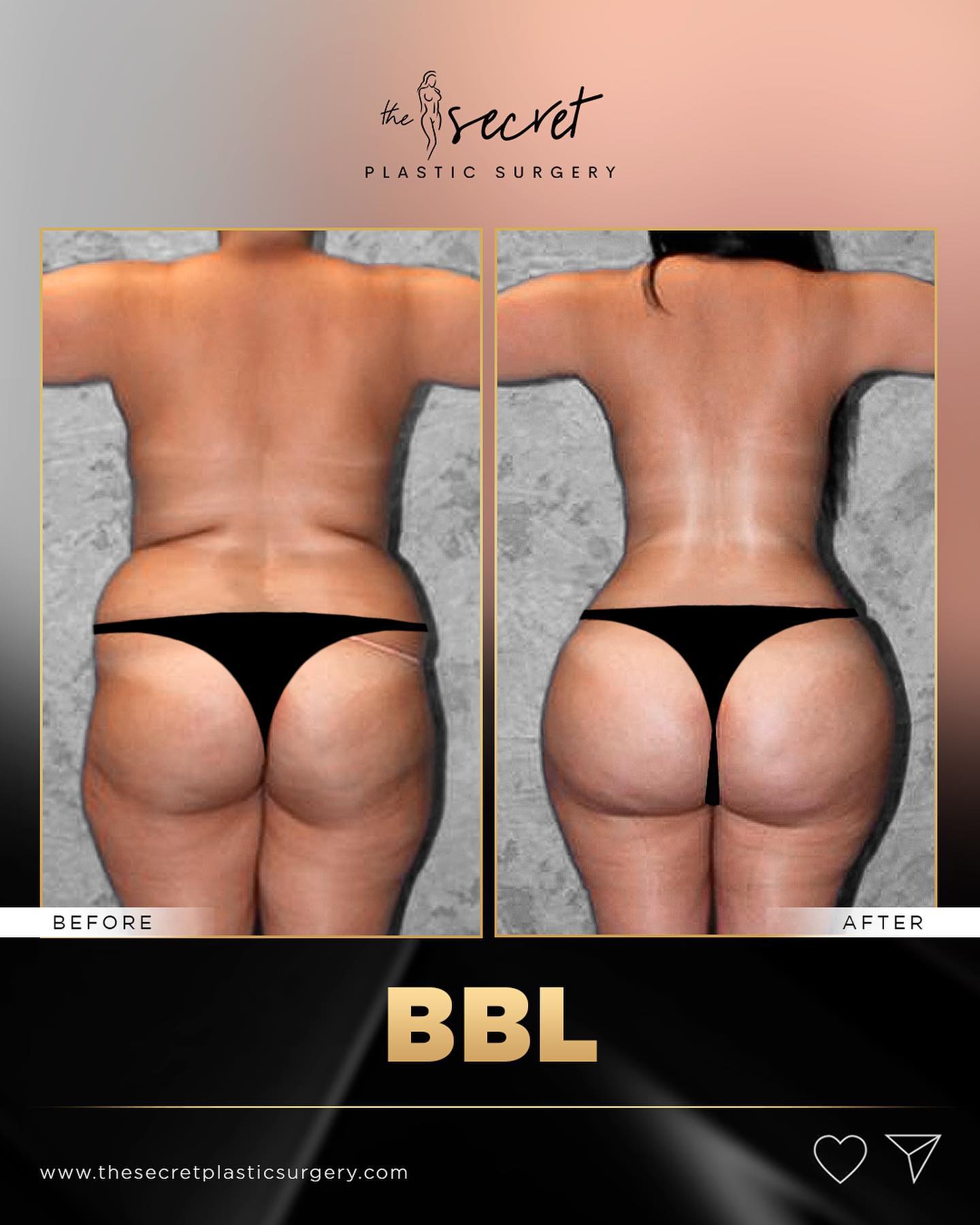 bbl plastic surgery