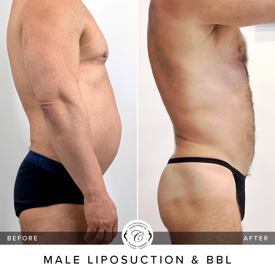 bbl plastic surgery