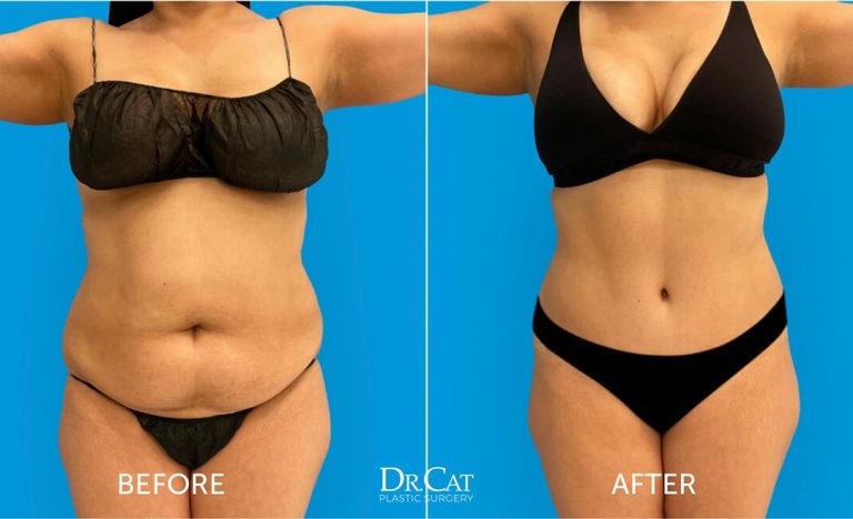 Belly Tuck: Achieving a flatter abdomen