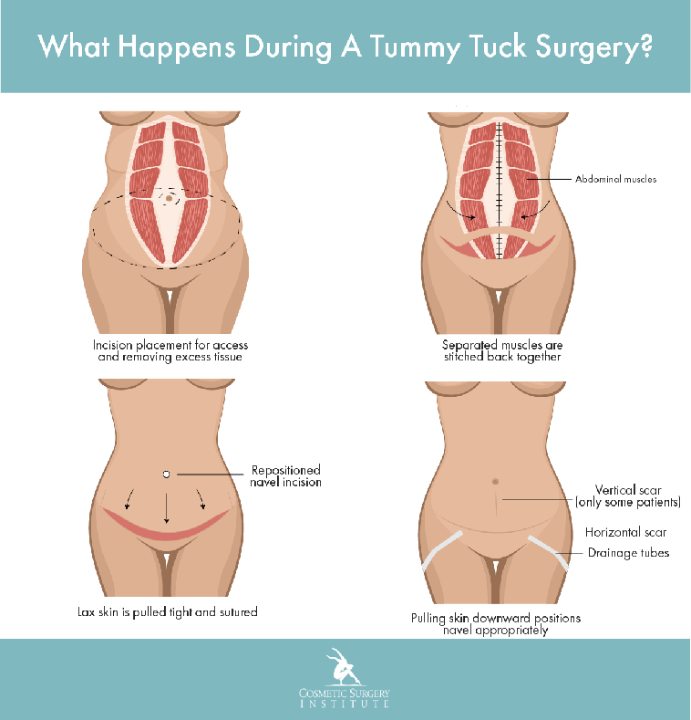 belly tuck