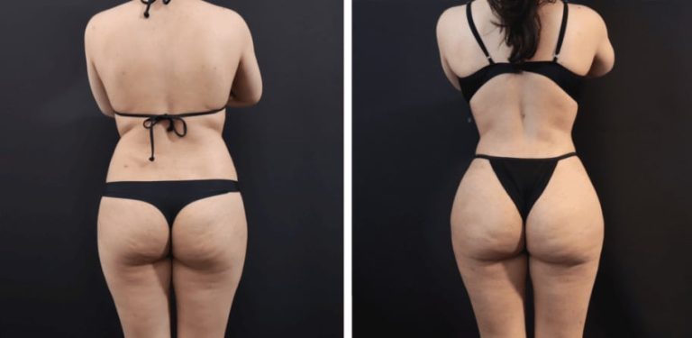 Best BBL surgeon: How to choose the right expert