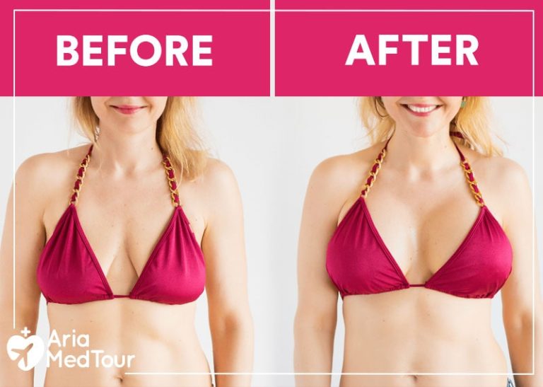 Best breast implants: Top options for natural-looking results