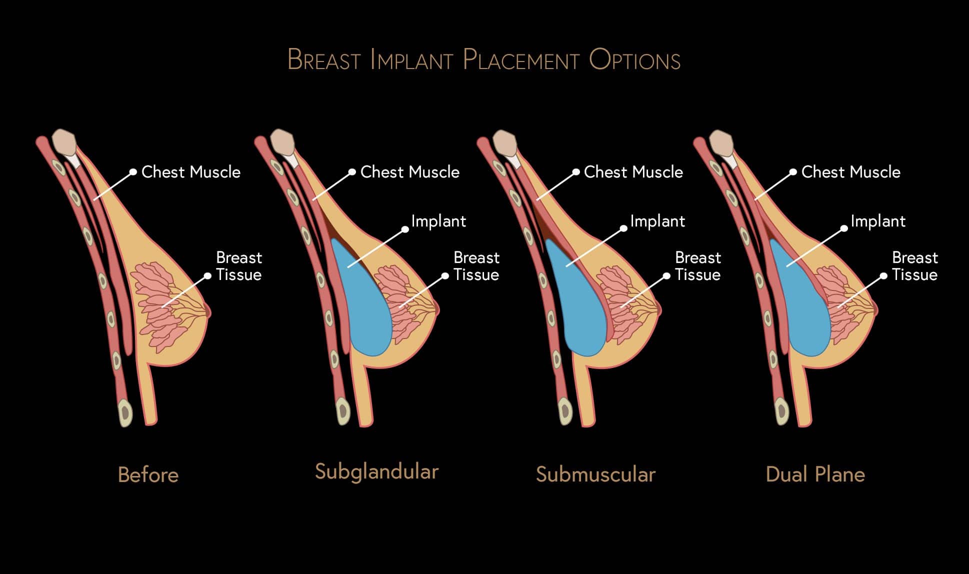 best breast implants best breast implants