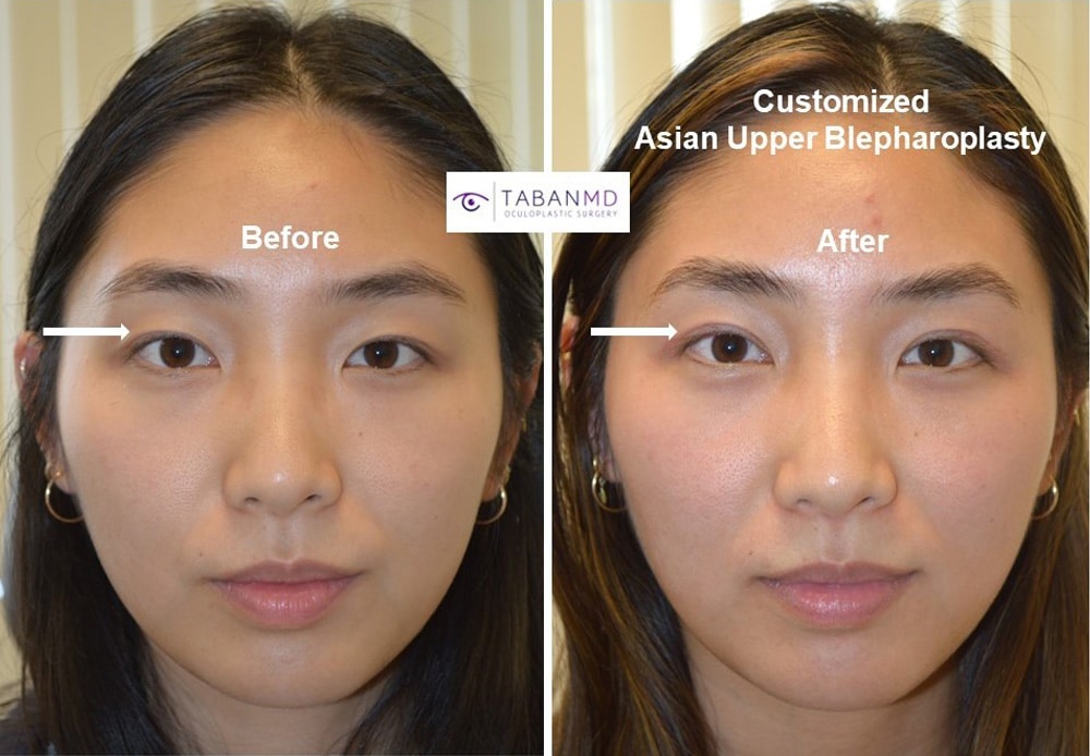 best eye cosmetic surgeon